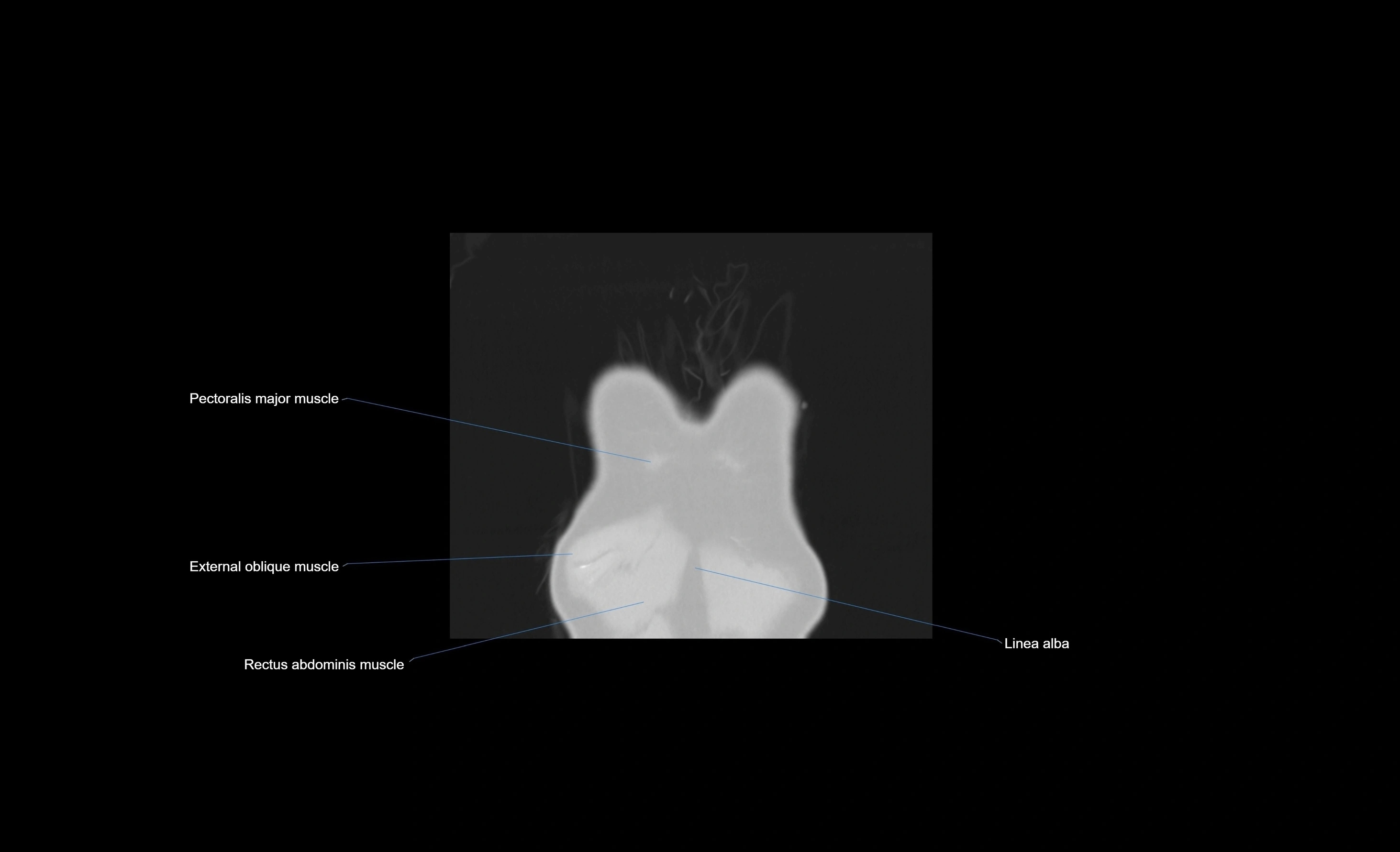 CT chest (thorax) lung window window labelled coronal cross sectional anatomy radiology image-00110.webp